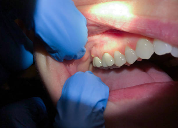 Best Tooth Infection Emergency Dentist  in Gardere, LA