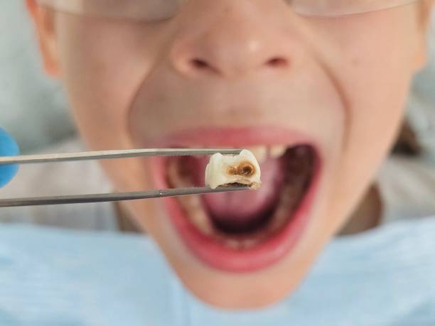Best Knocked-Out Tooth Emergency  in Gardere, LA